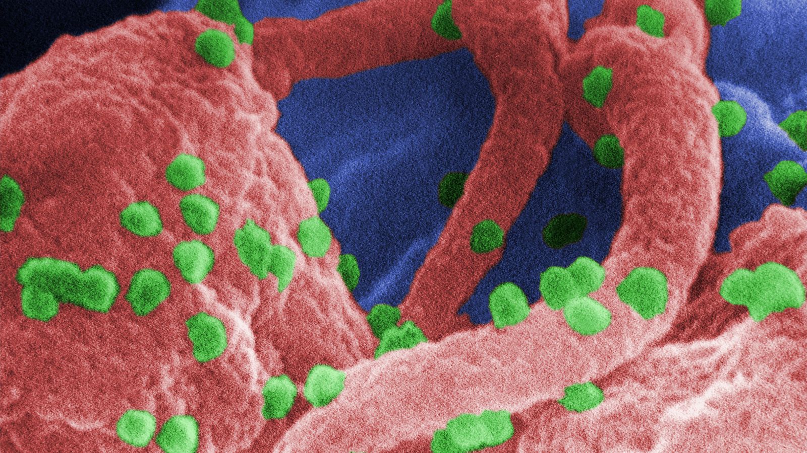 这张1989年的扫描电子显微镜（SEM）图像显示，在2019年3月5日从美国佐治亚州亚特兰大市疾病控制和预防中心（CDC）获得的这张图片中，培养的人类淋巴细胞中存在大量人类免疫缺陷病毒-1（HIV-1）病毒（外观呈球形）。